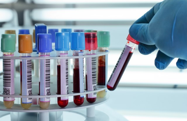Nauènici: Test krvi može pomoæi u ranom otkrivanju karcinoma